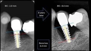 Figura 2. La pérdida ósea debe ser mayor a 2 mm entre la radiografía basal y cualquier otra tomada en el seguimiento.