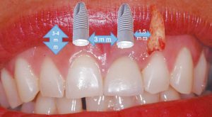 Figura 3. Principales determinantes biológicos (posicionamiento tridimensional). Distancia entre implante y diente, entre 1,5 y 2 mm; distancia entre implantes, 3 mm; distancia a las corticales 2 mm, profundidad de inserción entre 3 y 4 mm desde el límite amelo-cementario o el margen gingival.